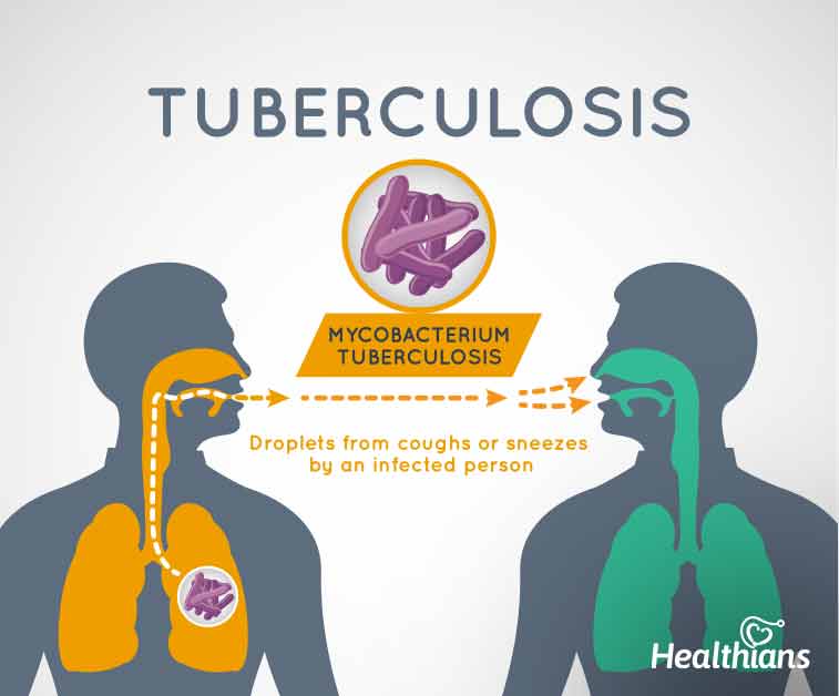 All you need to know about Tuberculosis or TB - HEALTHIANS BLOG